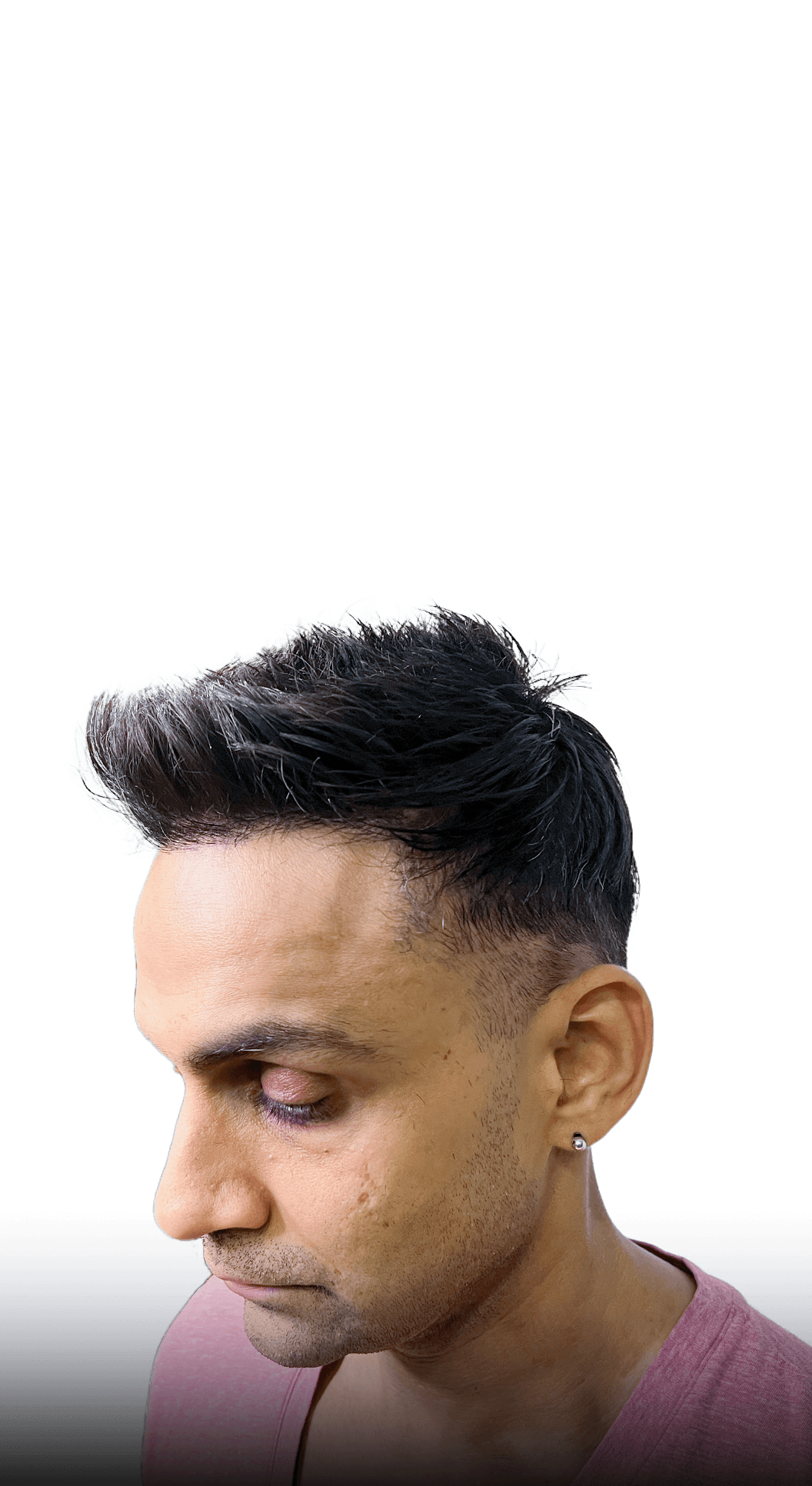 360 degree real look result from front hairline transplant and hair system combination method
