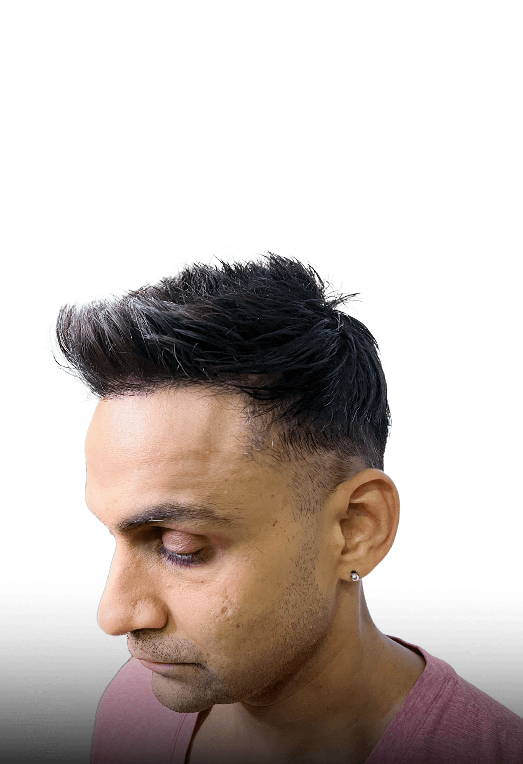 360 degree real look result from front hairline transplant and hair system combination method