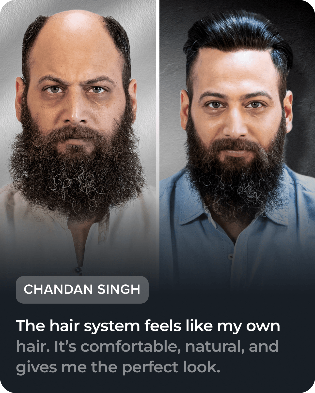 Before and after hair restoration testimonial, slide 5