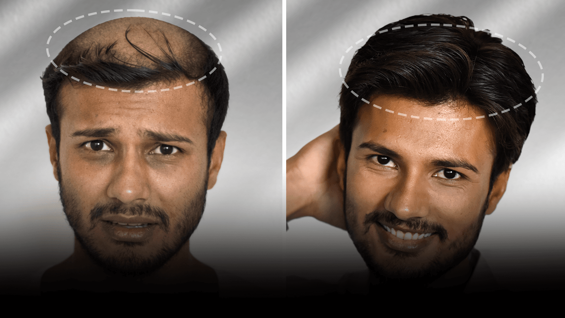 Before and after clip-on hair system result for Advik Sharma in the medium hair category.
