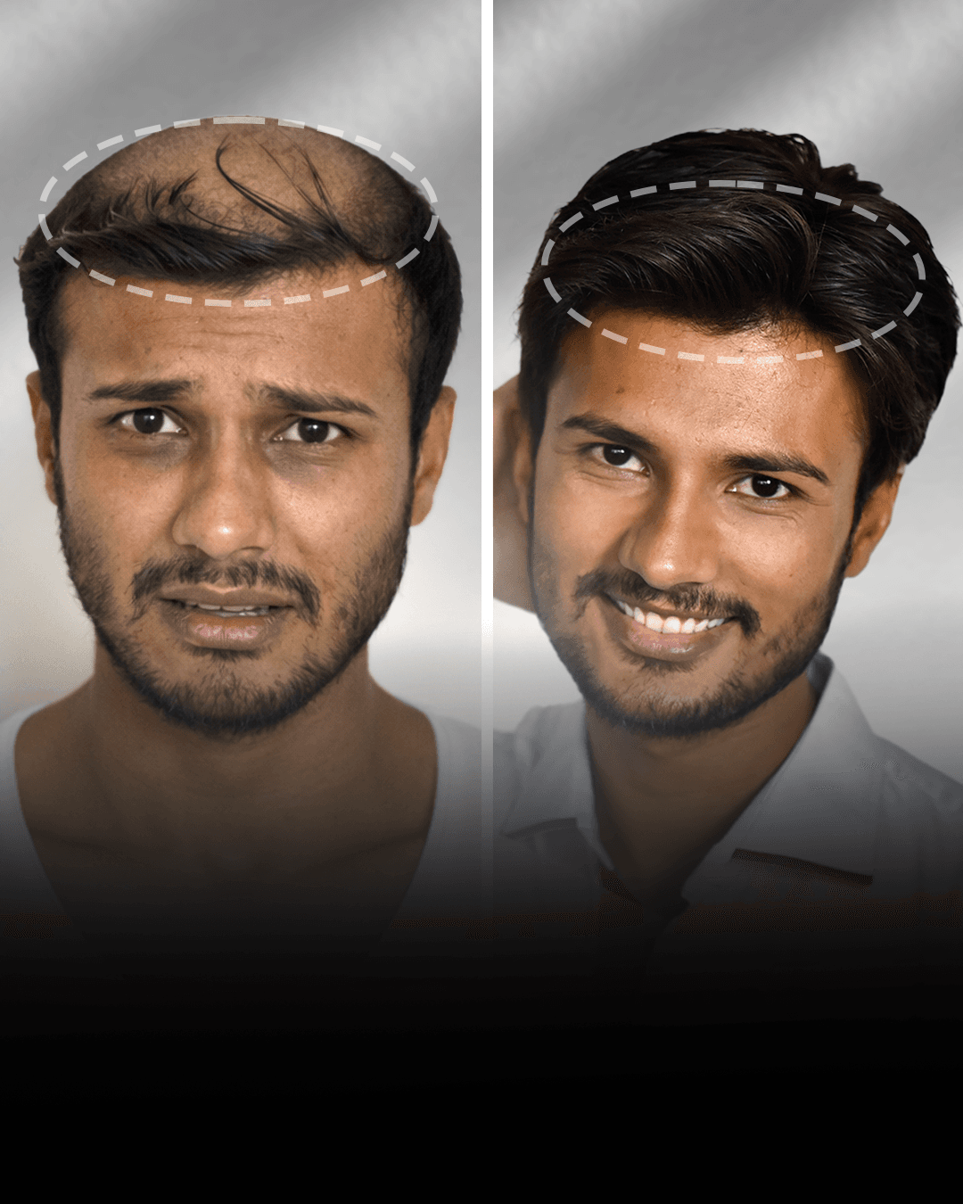 Before and after clip-on hair system result for Advik Sharma in the high density category.