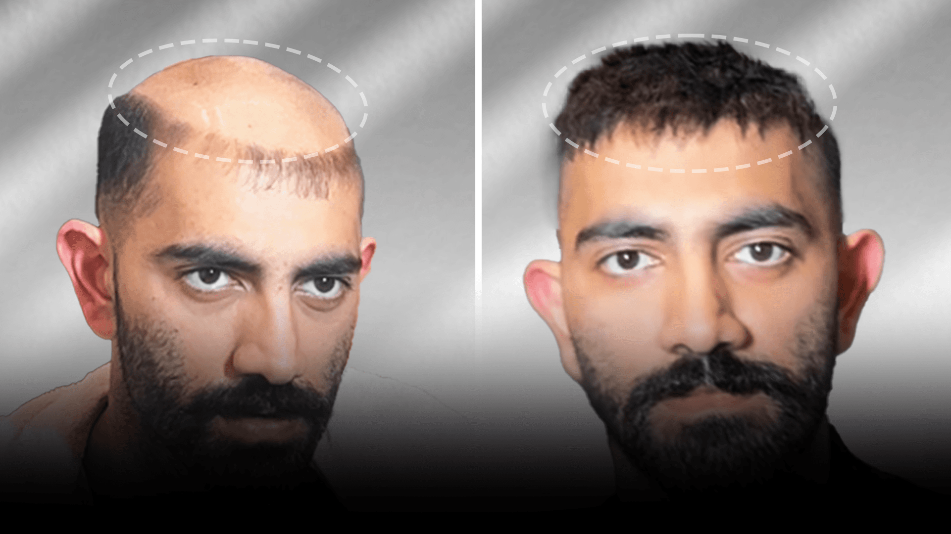Before and after stick-on hair system result for Azhar Shaikh in the short hair category.