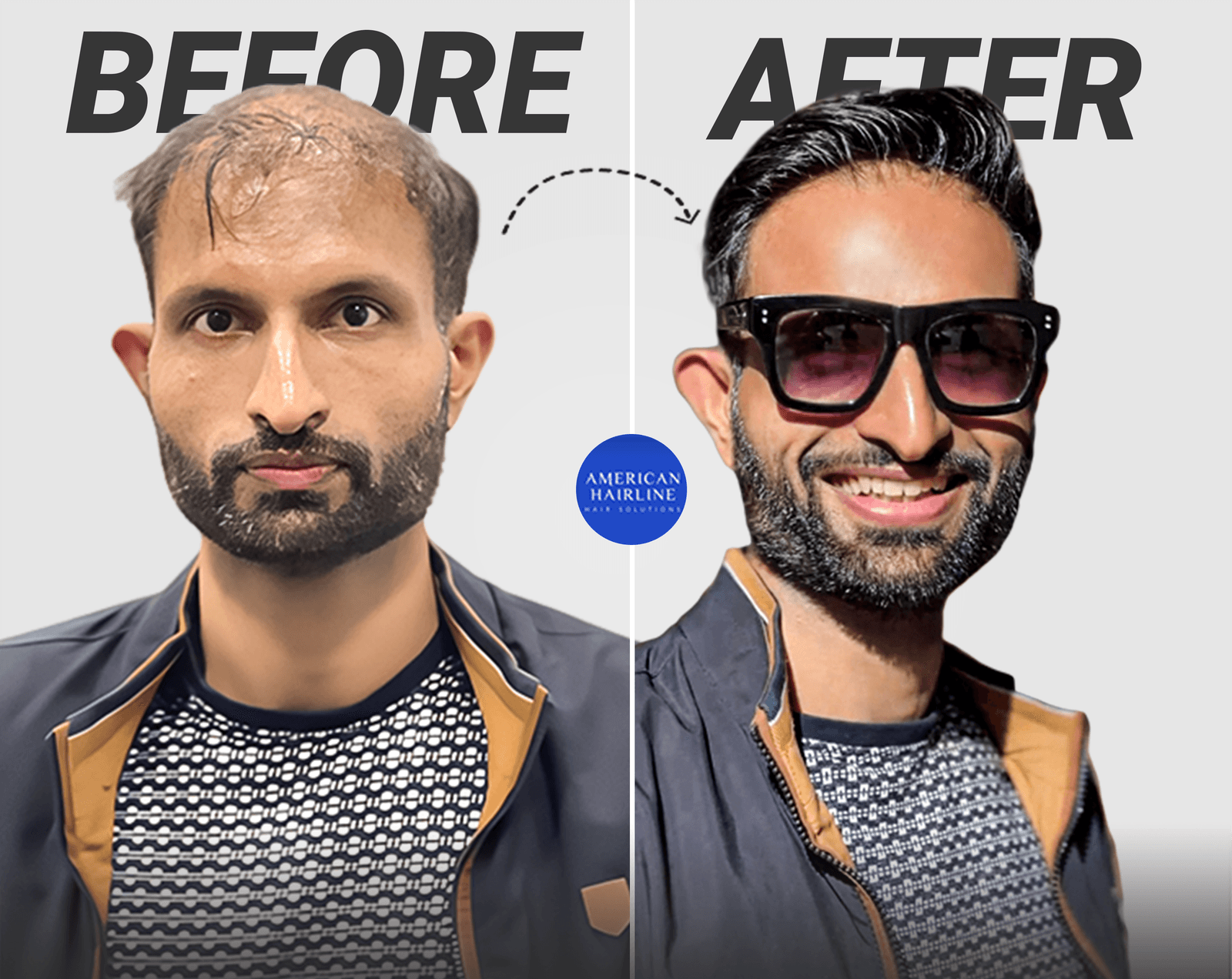 Hair Patches vs. Transplants: Which One Will Get You More Right Swipes?