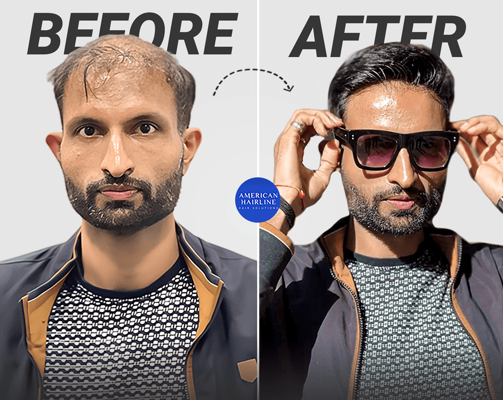 This Hair Solution Is Helping Indian Men Look Their Best Without Surgery