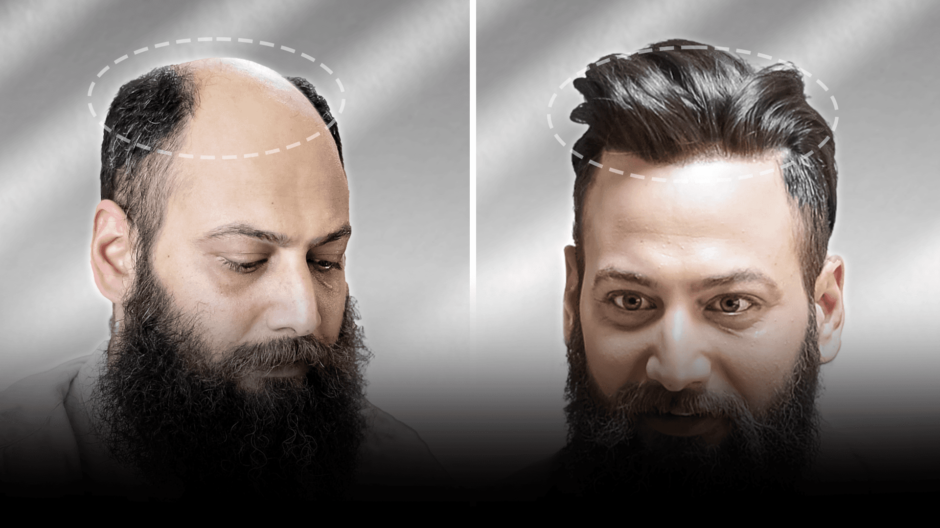 Before and after stick-on hair system result for Chandan Singh in the long hair category.