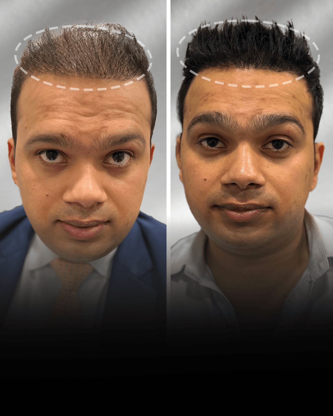 Before and after clip-on hair system result for Fuzail Khan in the low density category.