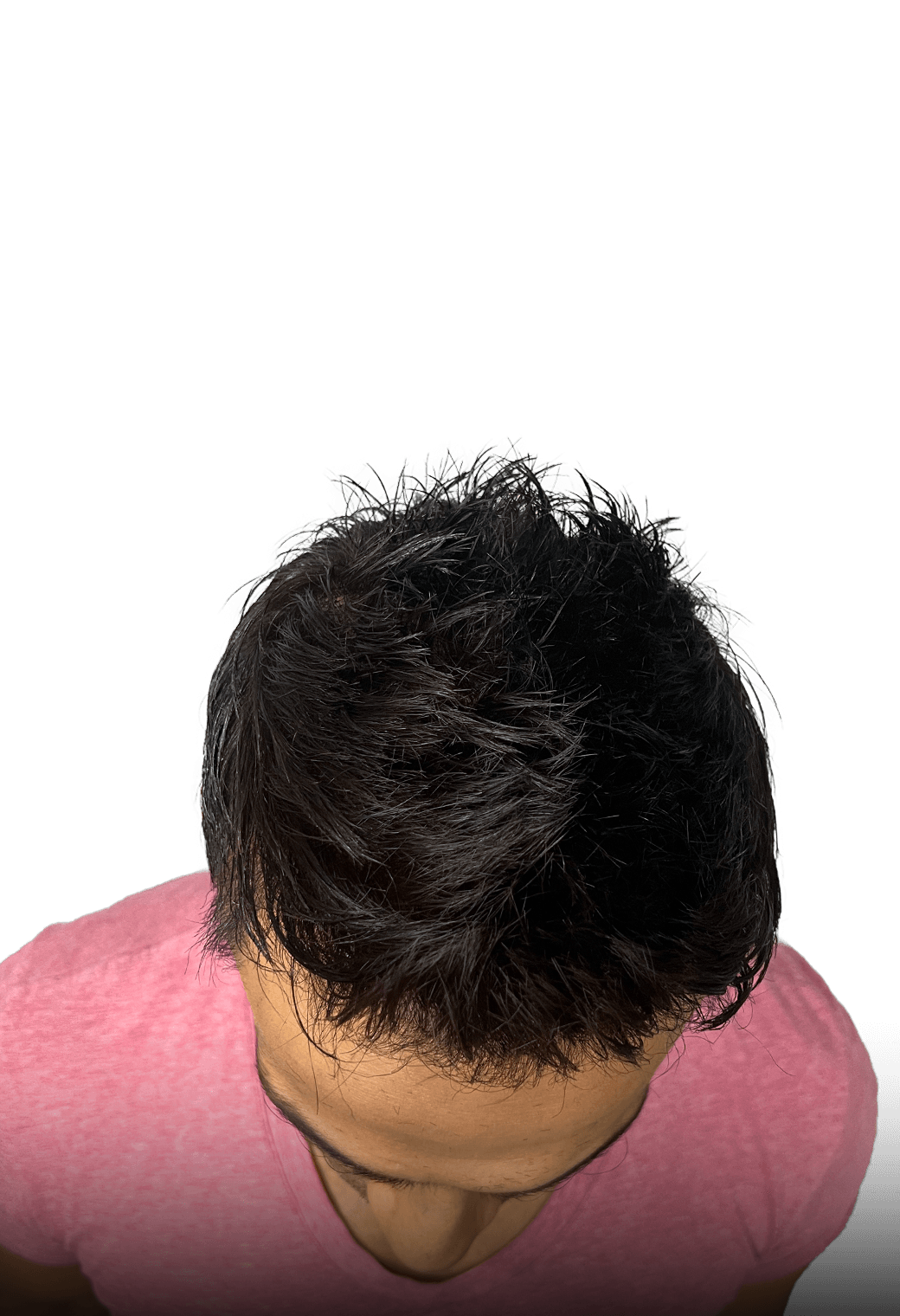 Full density result from front hairline transplant and hair system combination method