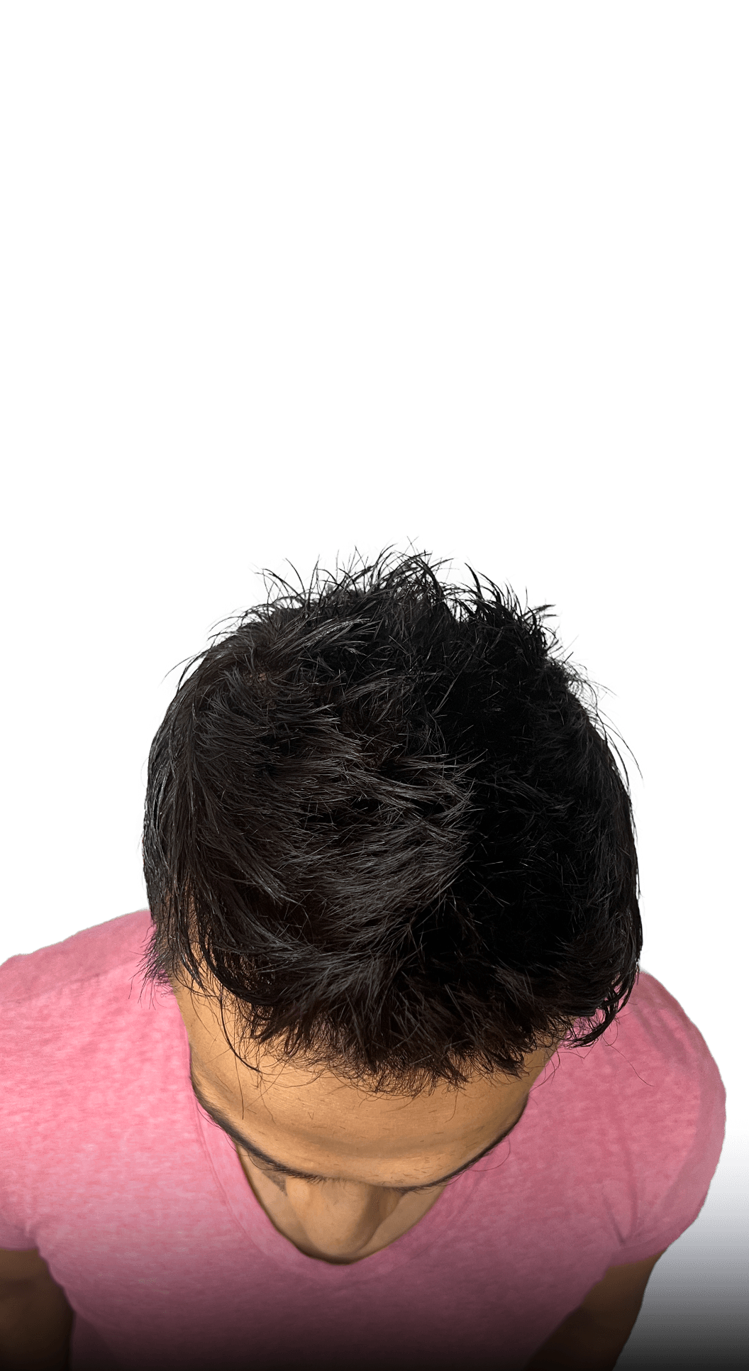 Full density result from front hairline transplant and hair system combination method
