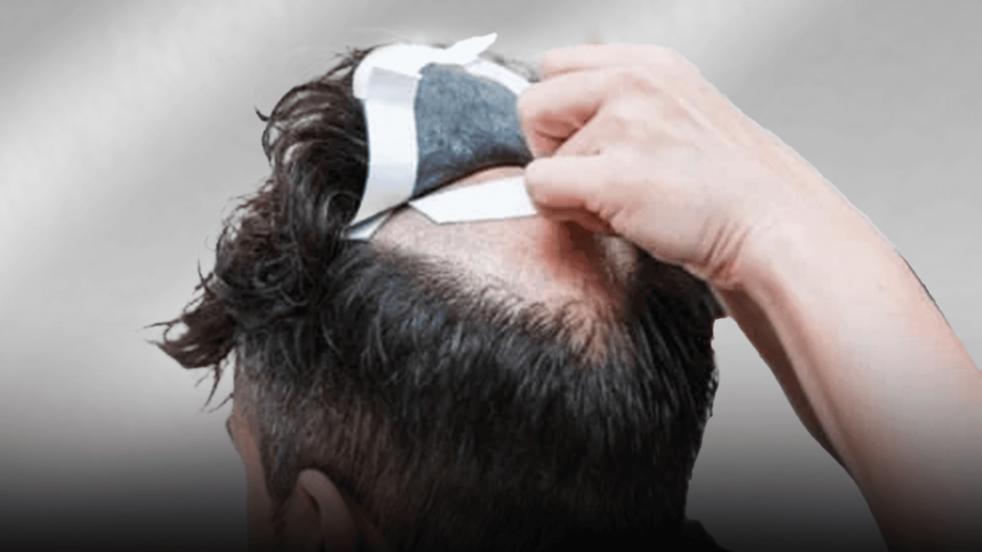 Non-surgical hair replacement service preview