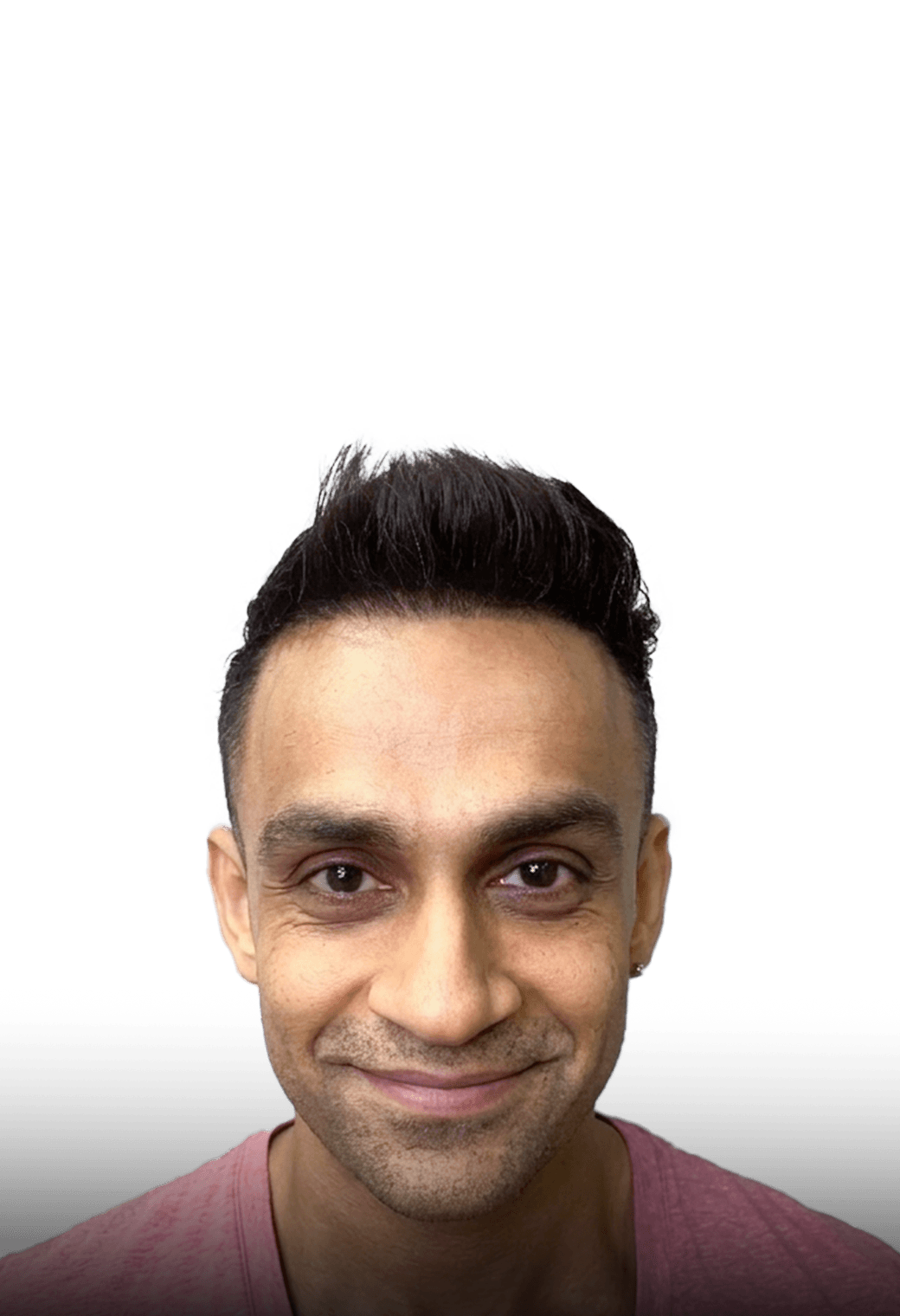 Natural hairline result from front hairline transplant and hair system combination method