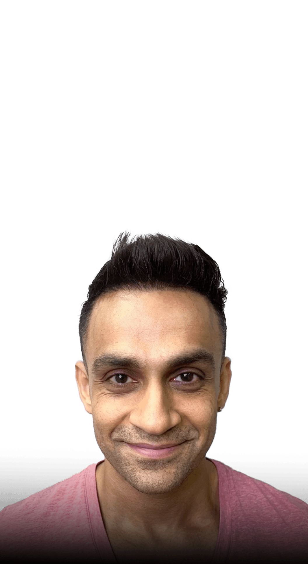 Natural hairline result from front hairline transplant and hair system combination method