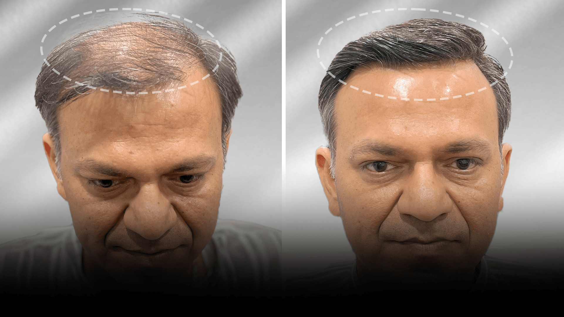 Before and after clip-on hair system result for Pankaj Bhatia in the medium hair category.