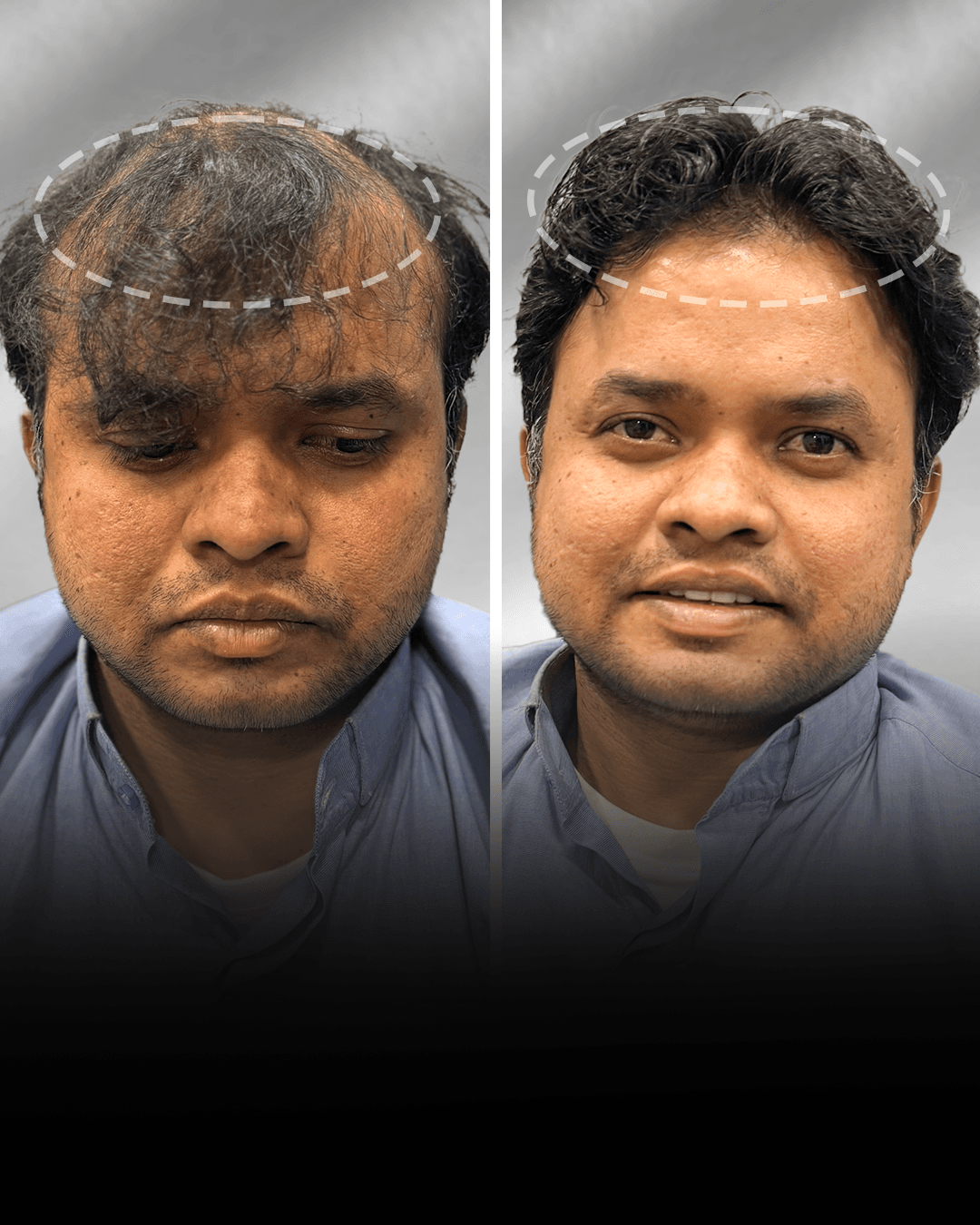 Before and after clip-on hair system result for Rahil Khan in the medium hair category.