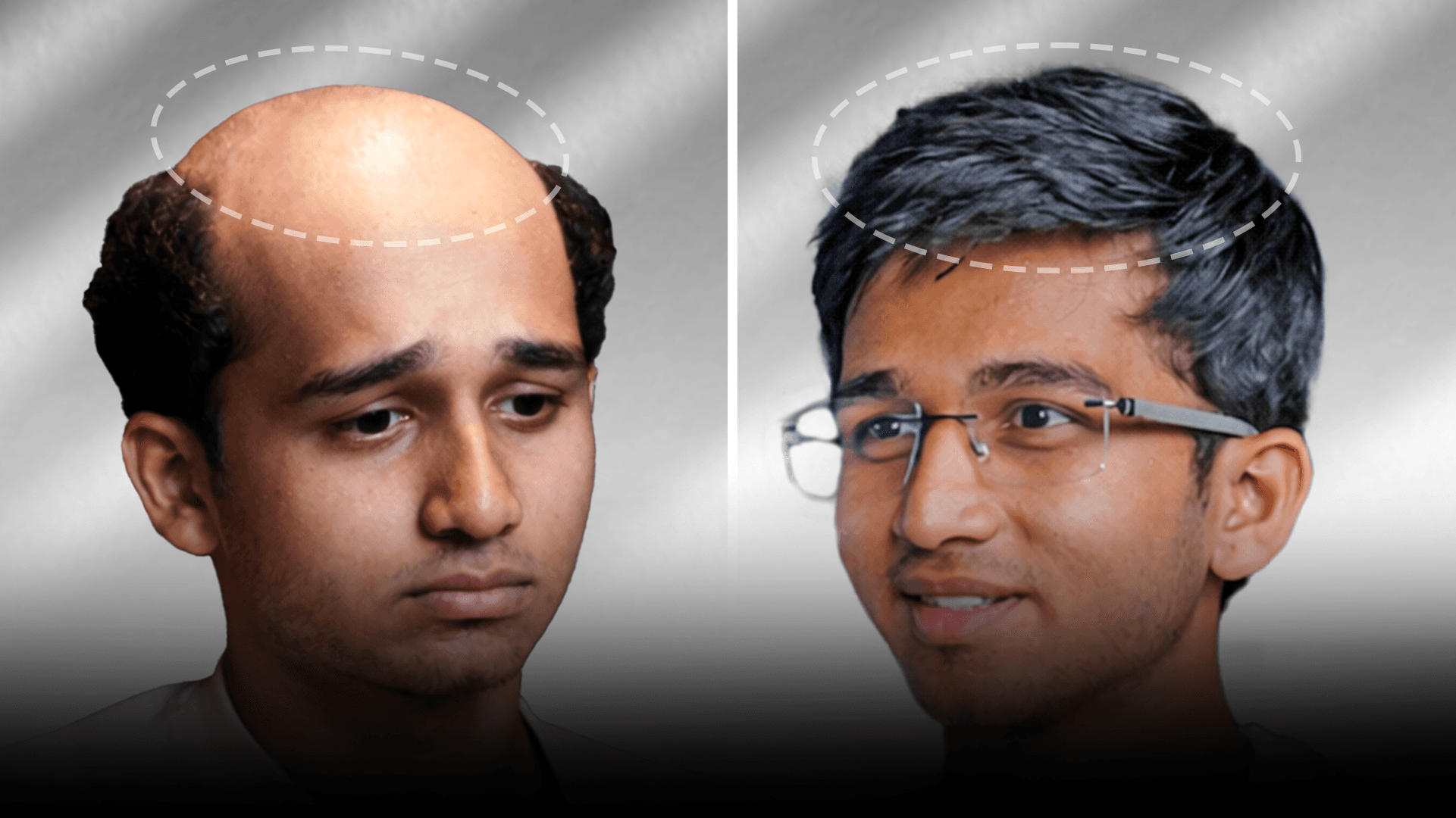 Before and after stick-on hair system result for Rohit Choudhary in the short hair category.