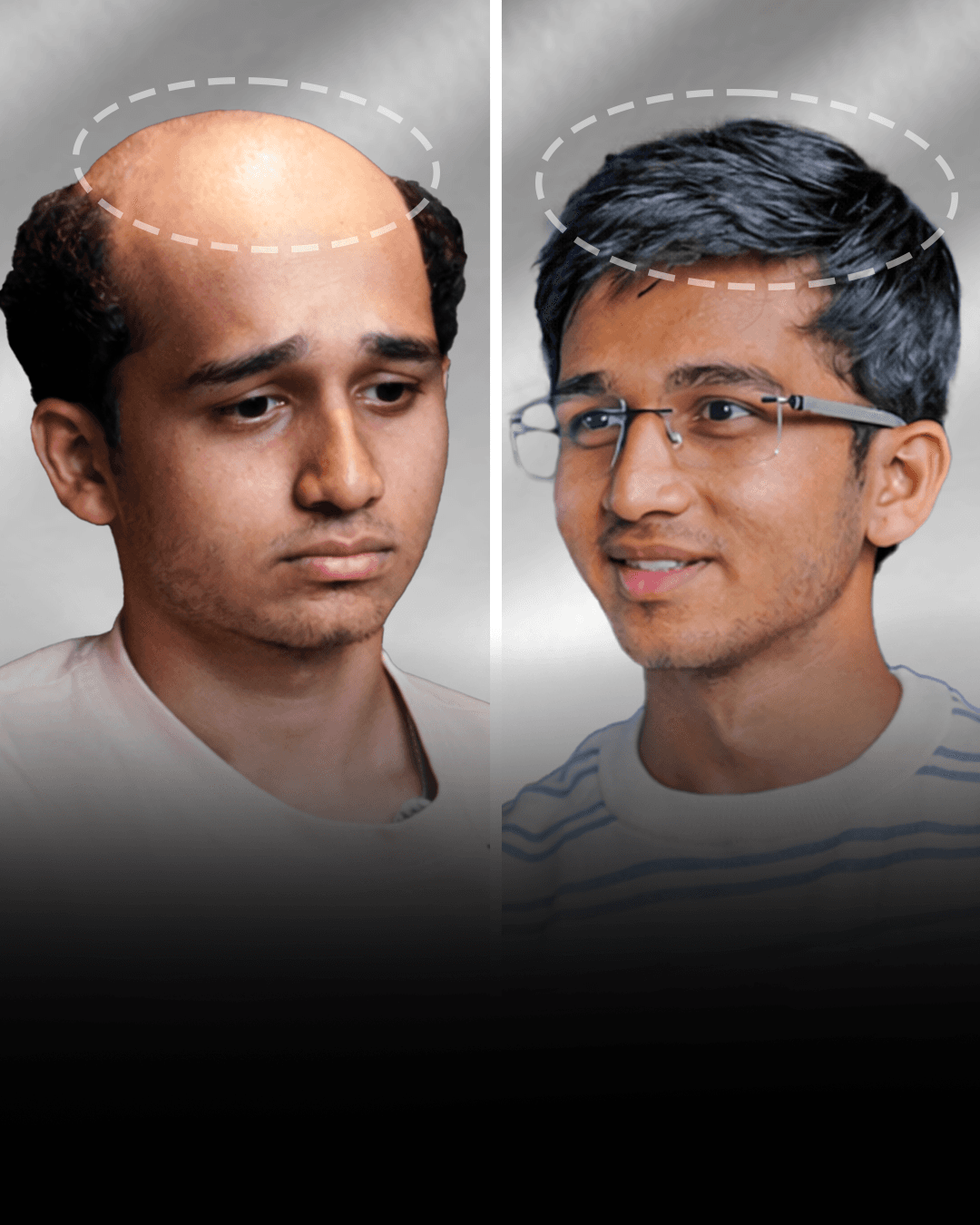 Before and after stick-on hair system result for Rohit Choudhary in the low density category.
