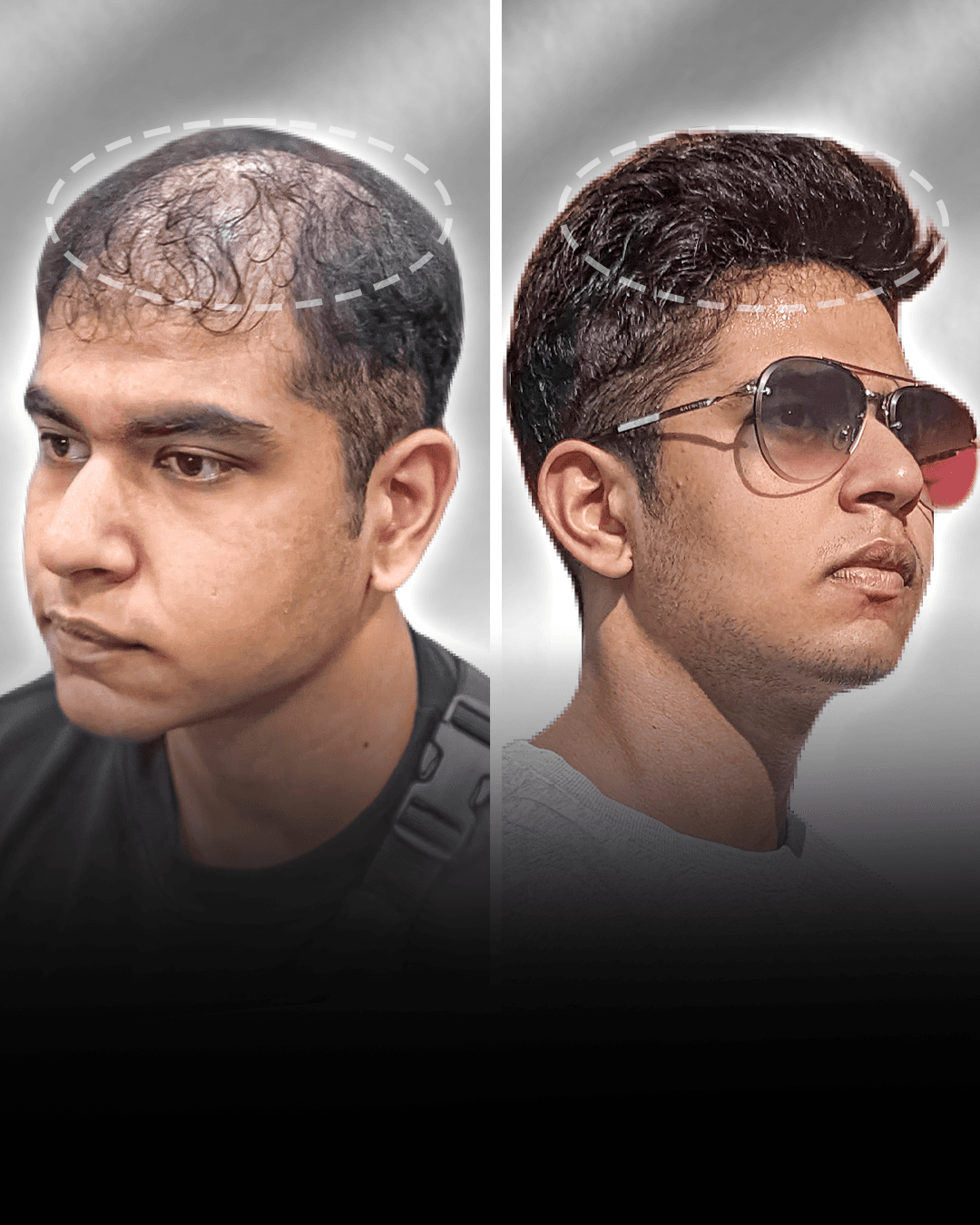 Before and after clip-on hair system result for Rylan Rodrigues in the medium hair category.