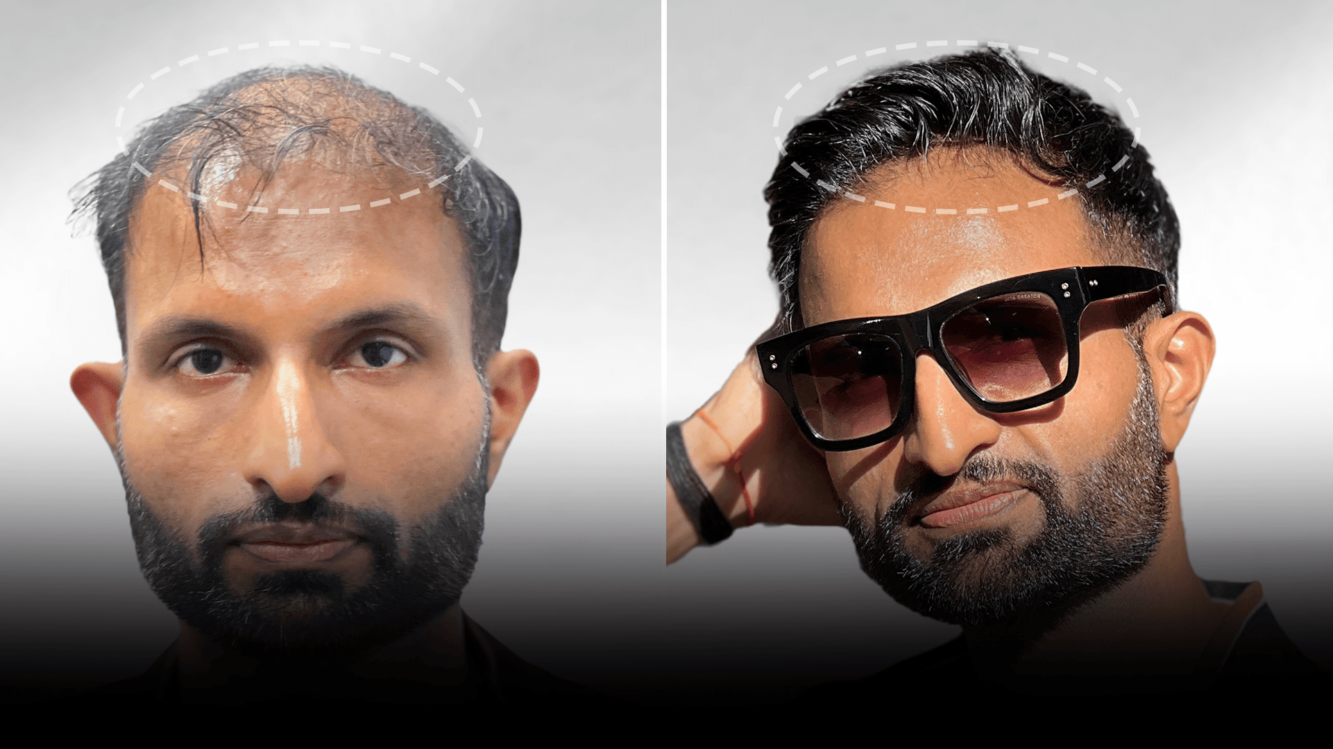 Before and after clip-on hair system result for Sahil Khan in the low density category.