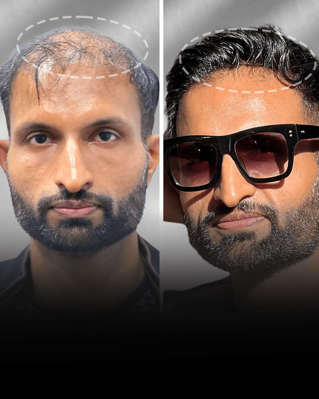 Before and after clip-on hair system result for Sahil Khan in the low density category.
