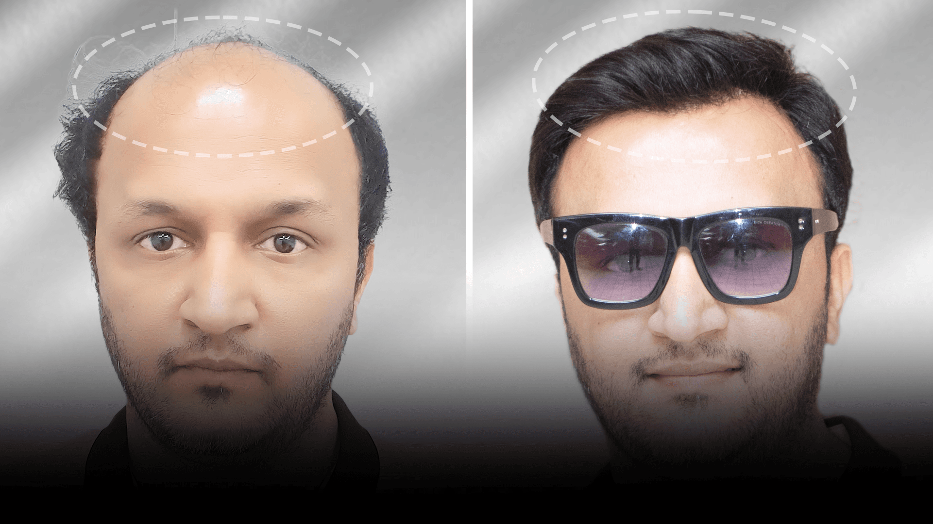 Before and after stick-on hair system result for Saurabh Mishra in the low density category.