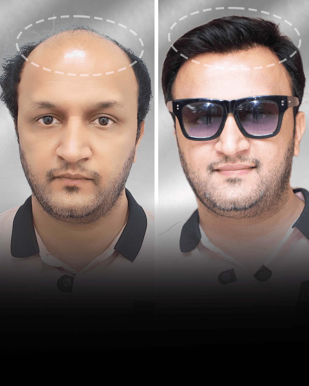 Before and after stick-on hair system result for Saurabh Mishra in the low density category.