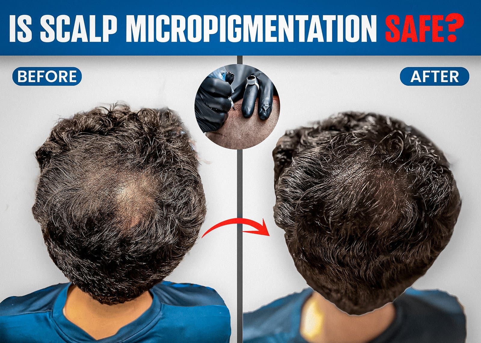 Can Scalp Micropigmentation Be Removed? Understanding the Reversal Process