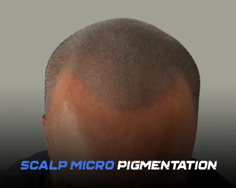 Scalp Micropigmentation Aftercare -  SMP Do's and Don'ts