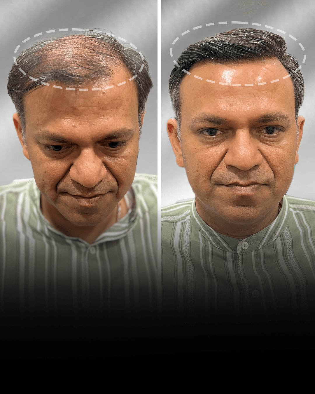 Before and after clip-on hair system result for Varun Desai in the high density category.