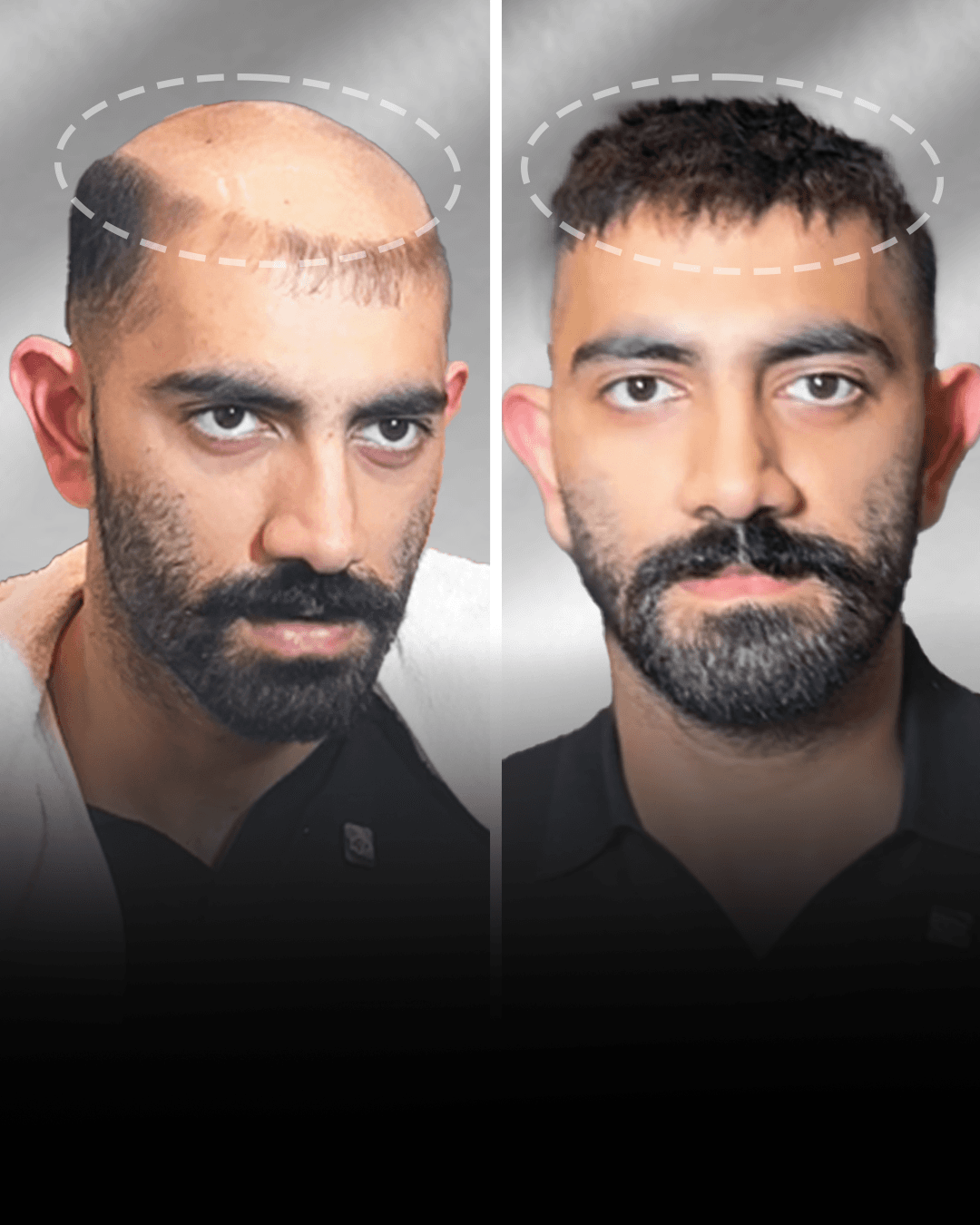 Before and after stick-on hair system result for Azhar Shaikh.