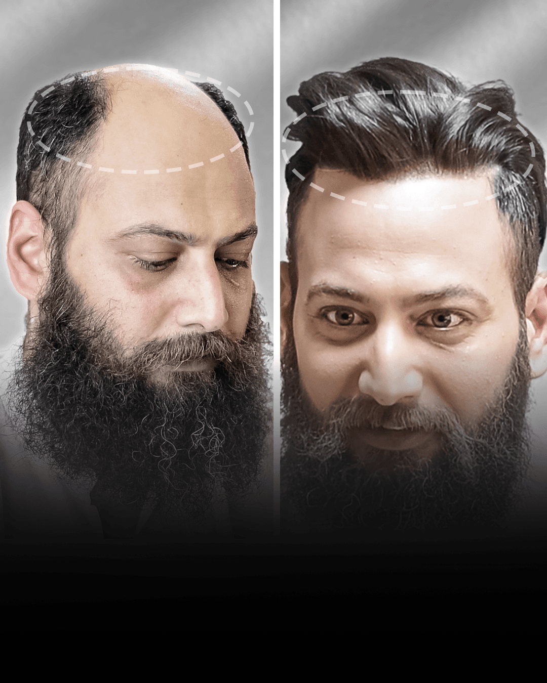 Before and after stick-on hair system result for Chandan Singh.