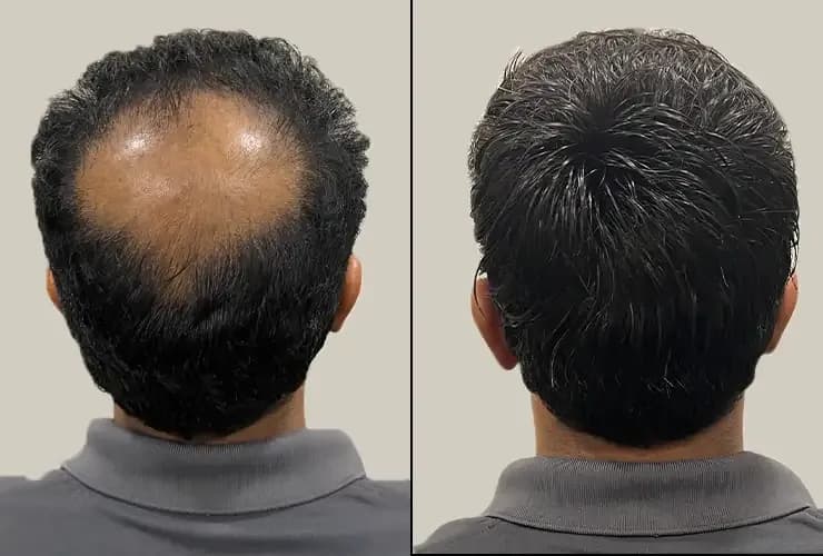 Does a Hair System Damage the Hair Underneath/Scalp?