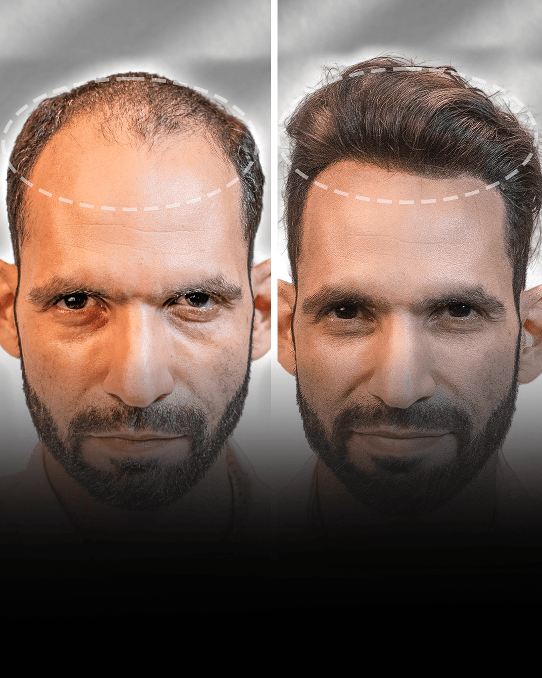 Before and after stick-on hair system result for Saurabh Mishra.
