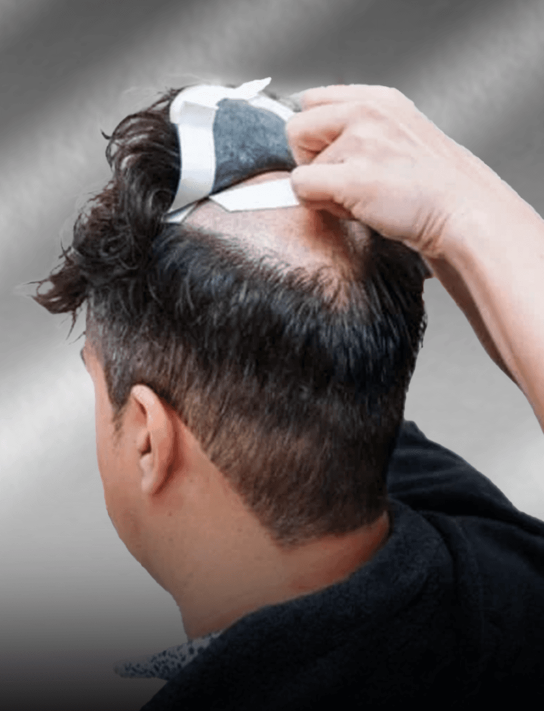 Non-surgical hair replacement service preview