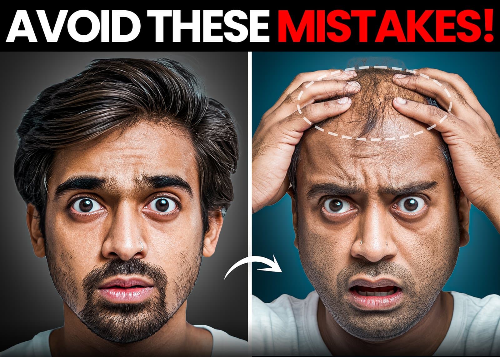 Why Do Most Men Fear Stick-On Hair Systems Look Fake?