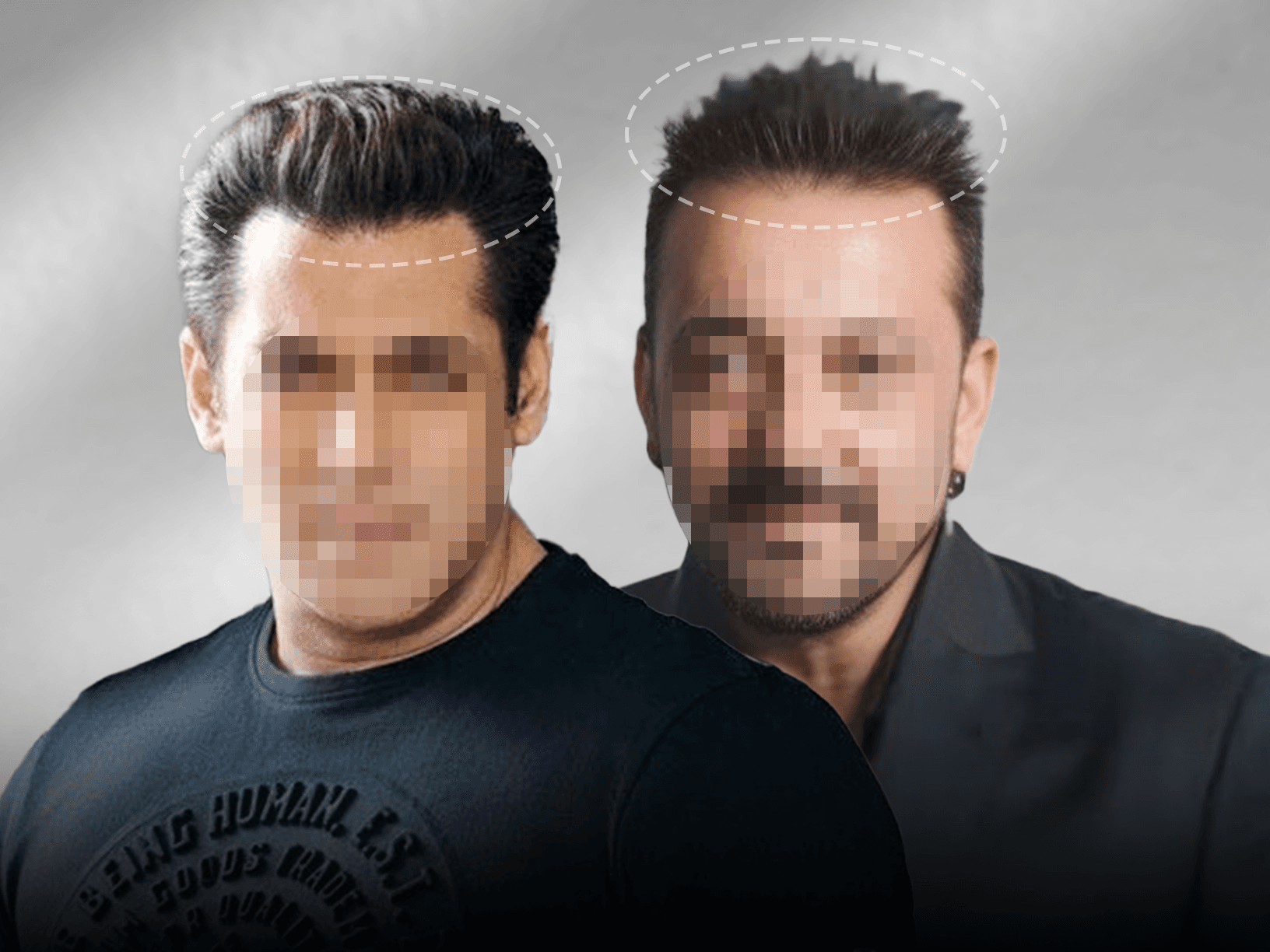 Bollywood actor with natural-looking hair — secret is the front hairline transplant and hair system combination method
