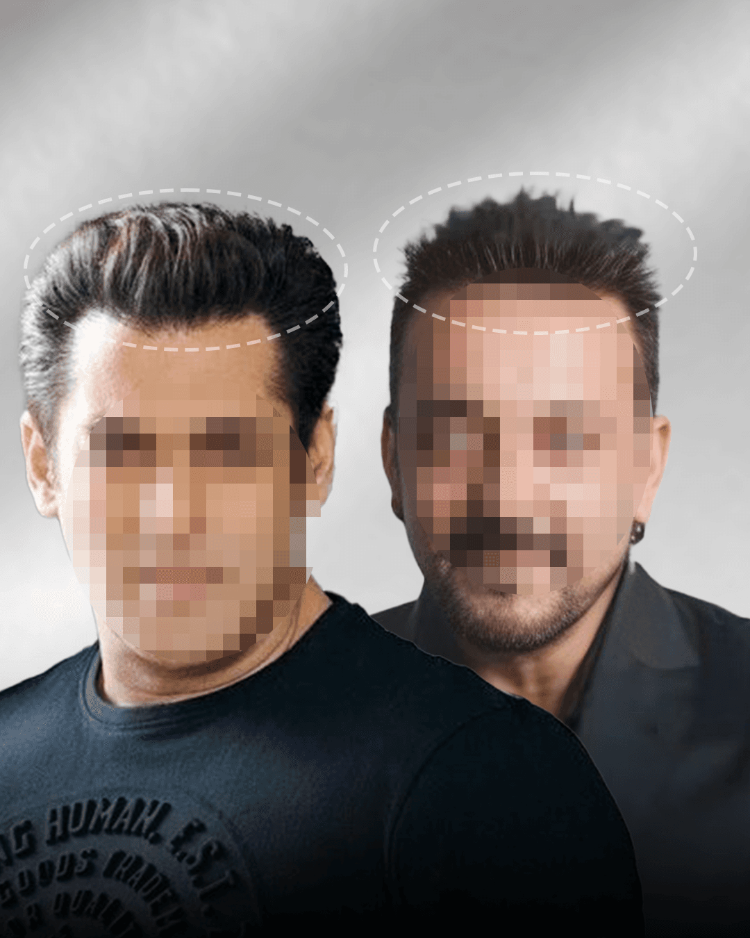 Bollywood actor with natural-looking hair — secret is the front hairline transplant and hair system combination method